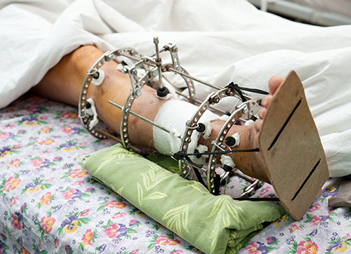 A person with many metal objects in their lower leg