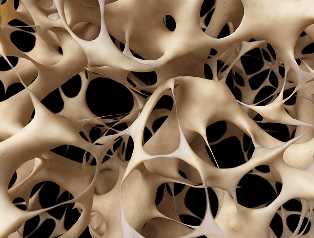 artist rendering of what osteoporosis looks like