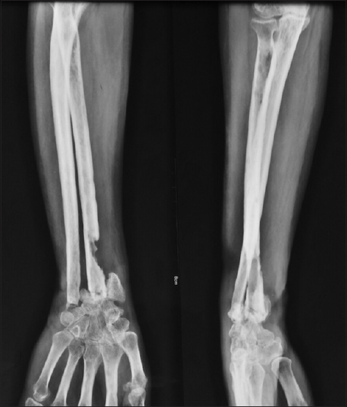 X-ray image of osteomyelitis bone infection