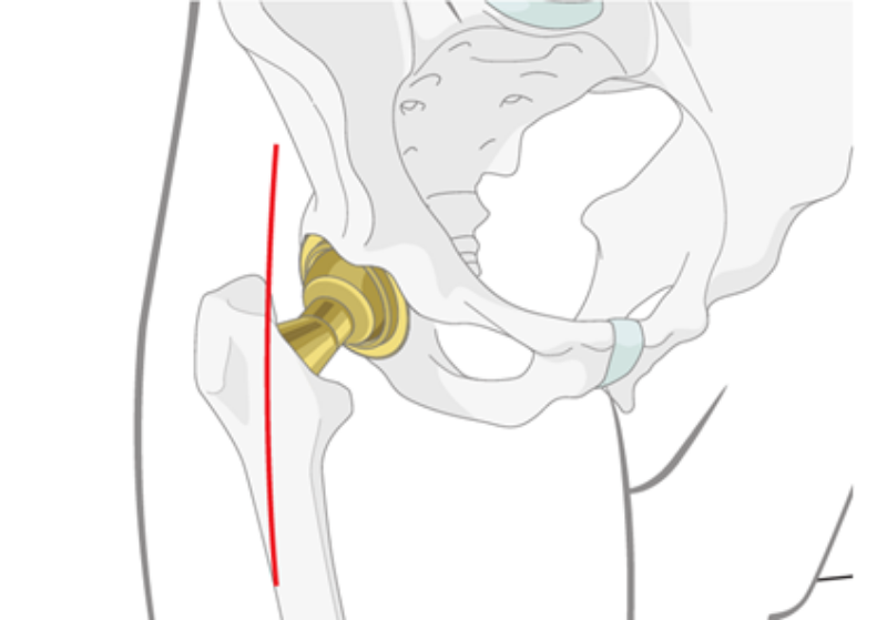 X-ray image of highlighted kneecaps